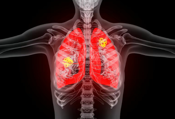 肿瘤进展也不一定要停药！部分晚期肺癌患者使用靶向药Zenocutuzumab已近4年