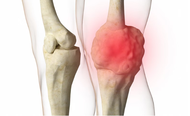 美国纪念斯隆凯特琳癌症中心：TIL疗法lifileucel治疗晚期肉瘤取得突破性疗效