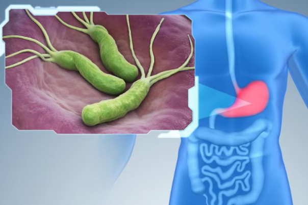 23岁博士生确诊晚期胃癌，再次敲响警钟！胃癌风险与体检筛查攻略