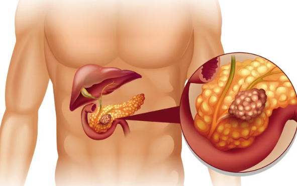 又一胰腺癌新药获批进入临床:SIL204靶向KRAS突变,覆盖约90%的患者