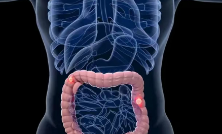 晚期肠癌肝转移真的还有可能治愈？赴日本癌研有明医院真实就医案例