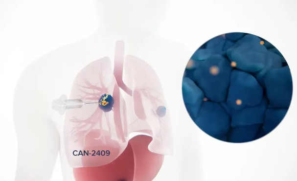 美国病毒免联合疫疗法CAN-2409让晚期肺癌患者生存期翻倍