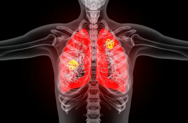 美国新药动态：疾病控制率89%，对脑转移患者也有效！晚期肺癌新药Zipalertinib提交加速审批