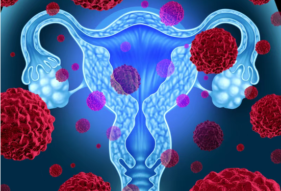 新药REGN5668联合免疫治疗，为几乎无药可用的铂类耐药卵巢癌和子宫内膜癌带来新方案