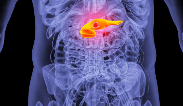 美国新药Ampligen将开展3期临床试验，治疗晚期胰腺癌