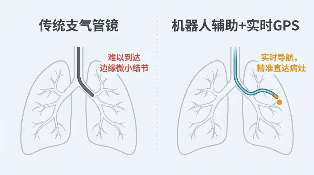 传统支气管镜与机器人辅助支气管镜的对比图解