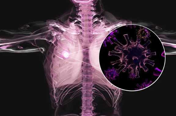 肺癌四代靶向药新进展!TRI-611获美国FDA快速通道资格,为ALK阳性肺癌耐药患者带来新希望