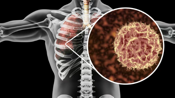 23%晚期肺癌患者活过6年！Libtayo/Cemiplimab疗效和安全性全面碾压化疗