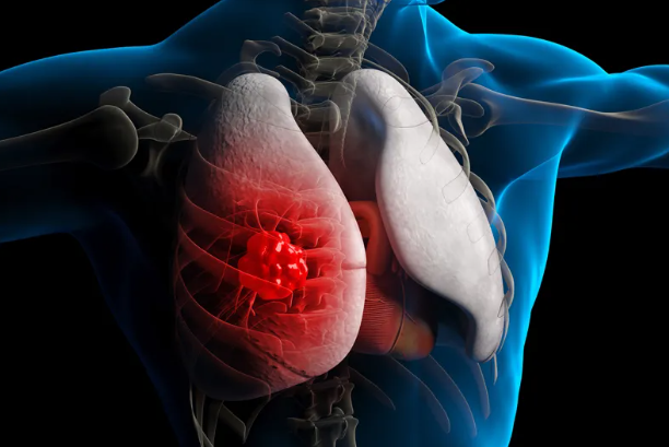 美国二期临床研究：Ateganosine序贯Libtayo疗法助力8名晚期肺癌患者生存期突破2年