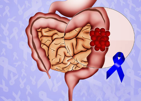 美国新药PDS01ADC联合疗法在转移性结直肠癌中效果显著，尤其肝转移患者