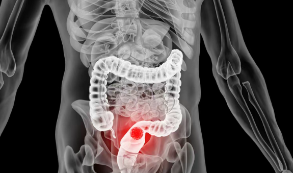 美国纪念斯隆凯特琳癌症中心(简称MSK)新策略颠覆传统治疗：HER2扩增型直肠肿瘤患者或许可以不手术了！