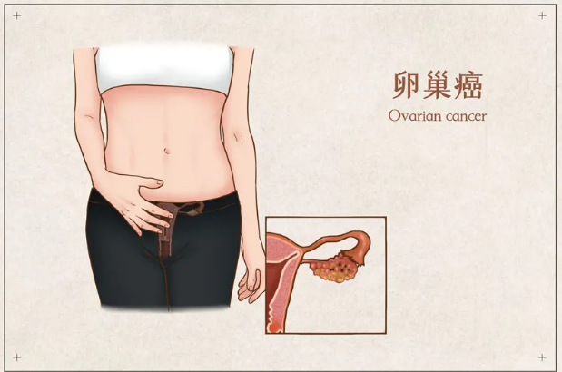 美国上市新药:晚期卵巢癌新希望!CTIM-76获美国FDA快速通道资格,用于铂类耐药卵巢癌患者