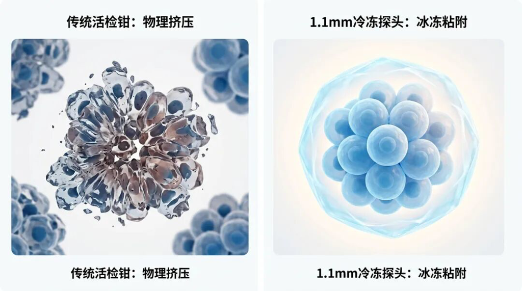 一张对比医学插画:左侧展示了传统活检钳因物理挤压导致的细胞变形和破碎(挤压伪影);右侧展示了1.1mm超细冷冻探头通过冰冻粘附技术,像保护罩一样完整地获取高质量细胞簇,画面充满科技感与安全感。
