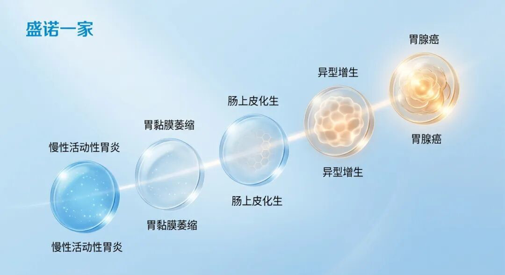 一张专业且具有国际化美感的医学插图,展示了‘科雷亚级联’的五个病理阶段:从慢性活动性胃炎、胃黏膜萎缩、肠上皮化生,到异型增生,最后演变为胃腺癌。画面采用品牌蓝调,通过五个半透明的微观组织切片意象呈现递进关系,最后两个阶段融入了温暖的琥珀色和金色光芒,整体风格干净、通透,传递出医学的严谨与希望。
