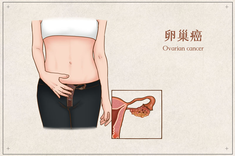 29岁女主持人不幸因卵巢癌去世，从确诊到离世仅几个月…这种癌症为何如此凶险？