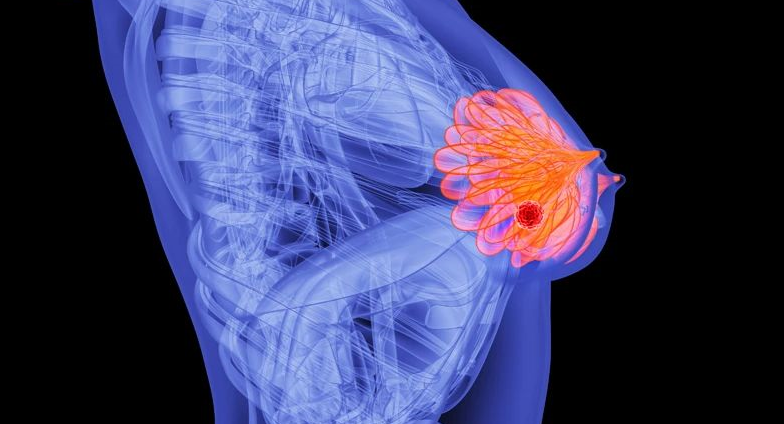 美国FDA批准晚期乳腺癌维持治疗方案：随访48个月，近一半患者肿瘤未进展！