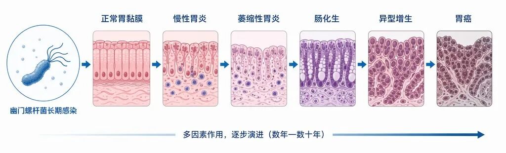 幽门螺杆菌导致胃癌演变的Correa级联反应示意图,展示从正常胃黏膜、慢性胃炎到胃癌的六个病理演变阶段。