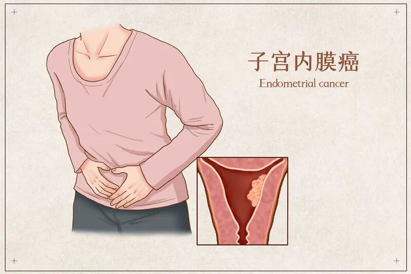 2026年ASCO年会:晚期或复发子宫内膜癌也能治愈!多塔利单抗联合化疗方案带来新可能!