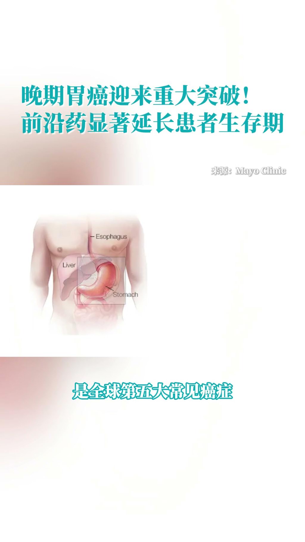 晚期胃癌迎来重大突破！前沿ADC药物Sone-Ve显著延长生存期